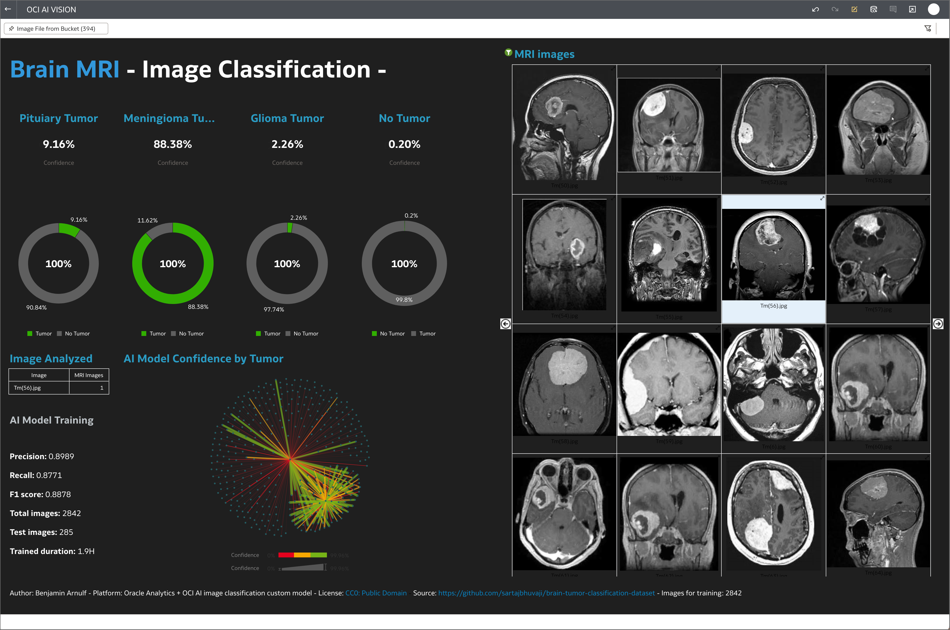 Oracle Analytics using Oracle AI Vision to recognize brain tumors on MRI pictures.